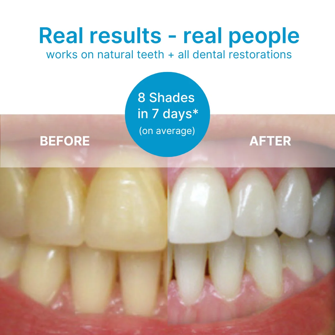 Fang® At-Home Pro Teeth Whitening Strips - Image 5